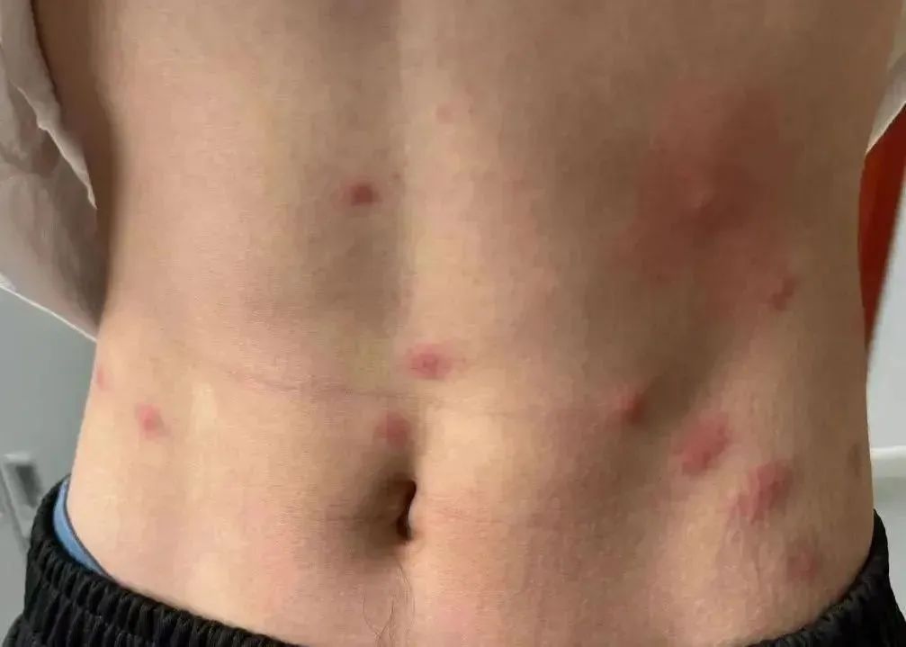 一觉醒来,身上密密麻麻都是……