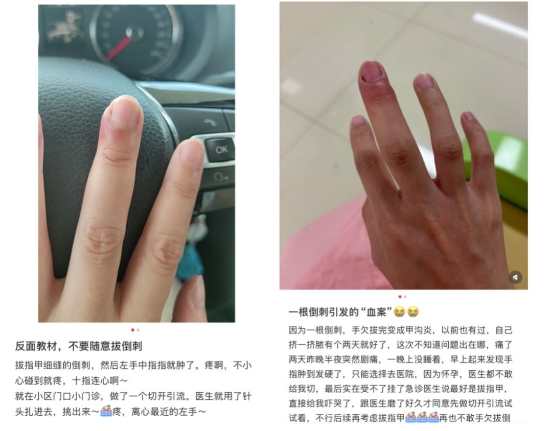 不要拔!有人进了急诊、截掉手指…… 不要拔!有人进了急诊、截掉手指……