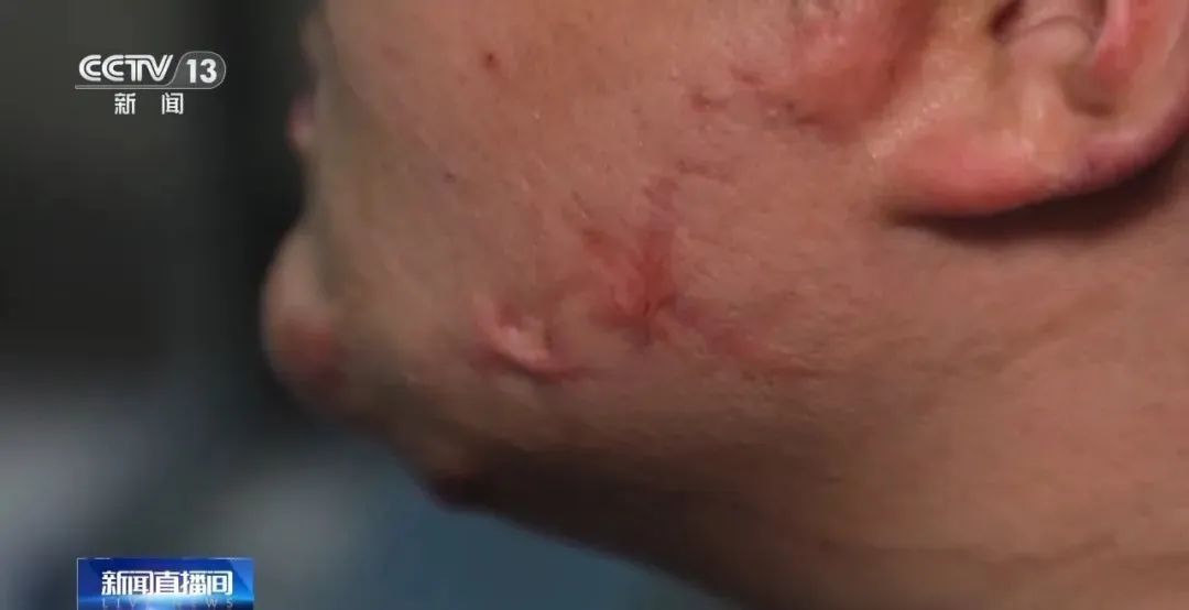 可在呼吸道爆燃!有学生吸食火机气体成瘾…… 可在呼吸道爆燃!有学生吸食火机气体成瘾……