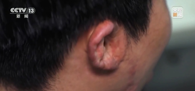 三人吸食它后引发爆炸,18岁少年全身严重烧伤!请小心这颗“移动雷” 三人吸食它后引发爆炸,18岁少年全身严重烧伤!请小心这颗“移动雷”