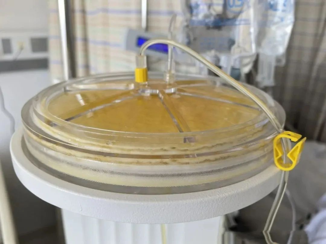 提醒!高发季来了,“以为睡一觉就好”,67岁上海阿姨差点就半身不遂 提醒!高发季来了,“以为睡一觉就好”,67岁上海阿姨差点就半身不遂