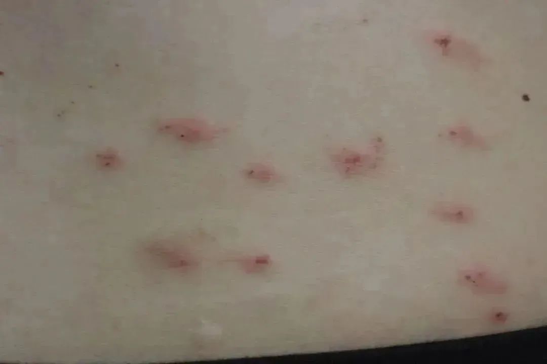 一觉醒来,身上密密麻麻都是……