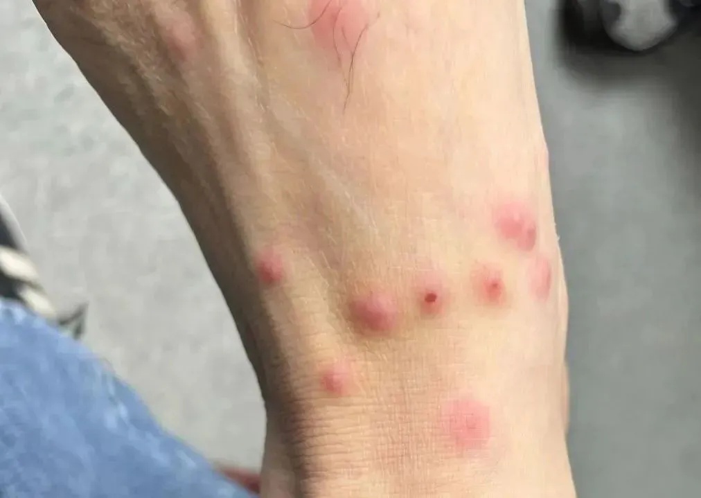 女子一觉醒来，身上密密麻麻全是！近期高发，家中有它要格外注意