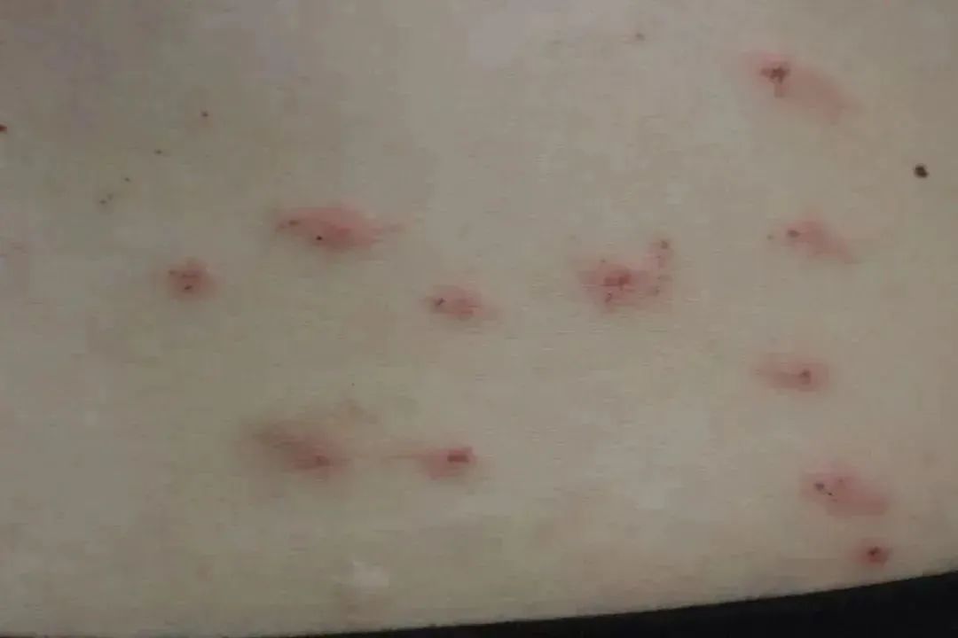 很多上海人家里都在用!一觉醒来,身上密密麻麻红疹!近期高发,罪魁祸首竟是…… 很多上海人家里都在用!一觉醒来,身上密密麻麻红疹!近期高发,罪魁祸首竟是……