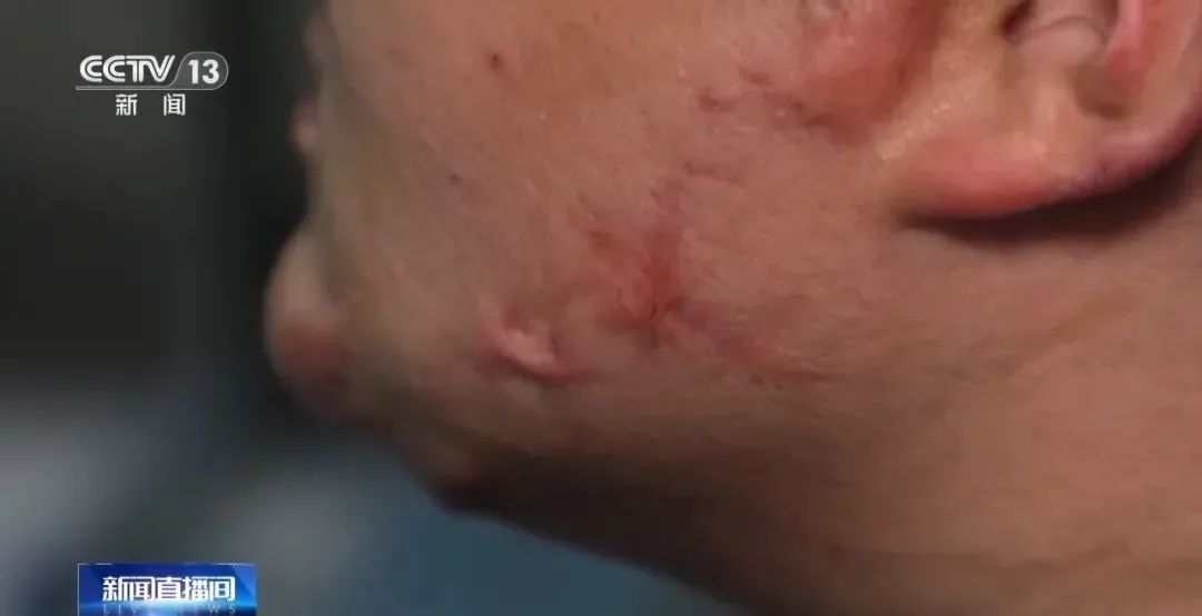 紧急提醒！有学生吸食火机气体成瘾，可在呼吸道爆燃……