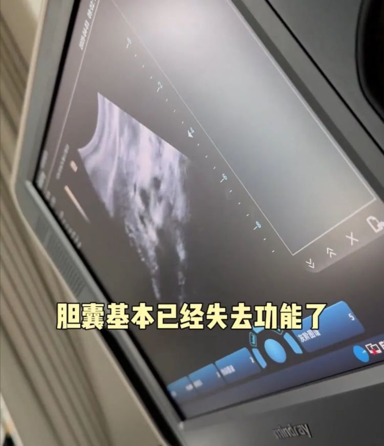 演员颖儿确诊胆结石，“胆囊已基本失去功能”