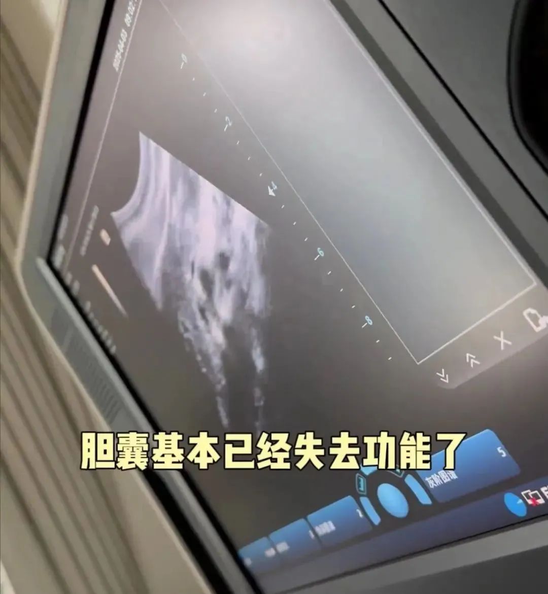 36岁知名女演员确诊，“已基本失去功能”！多位明星已“切除”，这种病与饮食、生活习惯有关