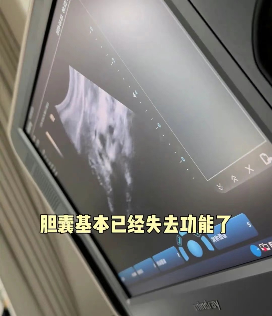 女演员颖儿自曝胆囊“已基本失去功能,手术切除了”,提醒:长时间空腹易引发 女演员颖儿自曝胆囊“已基本失去功能,手术切除了”,提醒:长时间空腹易引发