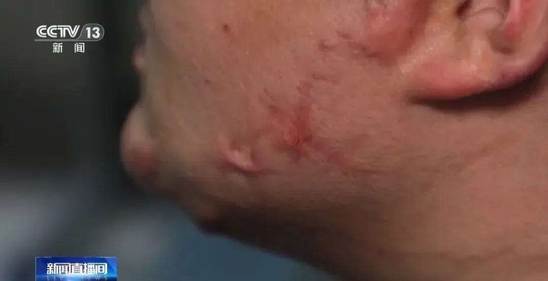 紧急提醒！有学生吸食打火机气体成瘾，可在呼吸道爆燃……