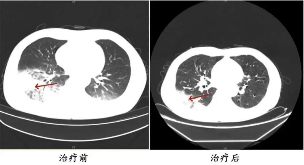 连吹3天空调致“白肺”,很多人都忽视了这点 连吹3天空调致“白肺”,很多人都忽视了这点