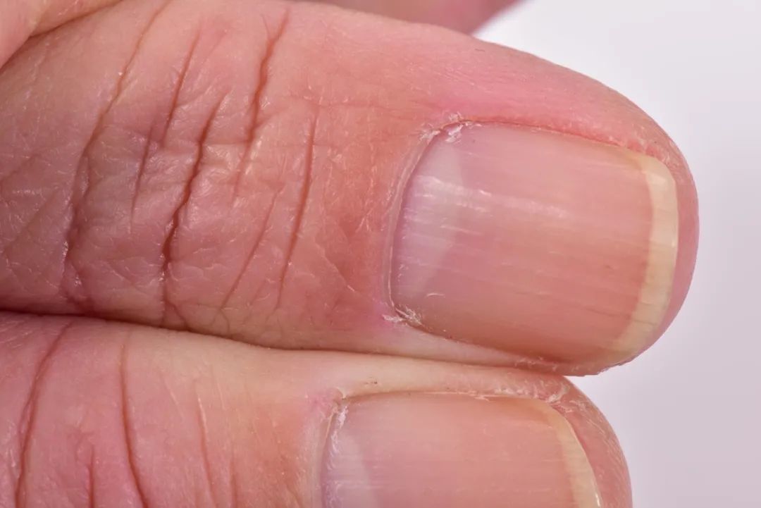 指甲上有竖纹说明身体有问题?真相来了! 指甲上有竖纹说明身体有问题?真相来了!