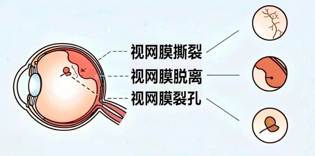 年轻小伙视网膜突然脱离,竟然和这个日常习惯有关,很多人都会做! 年轻小伙视网膜突然脱离,竟然和这个日常习惯有关,很多人都会做!