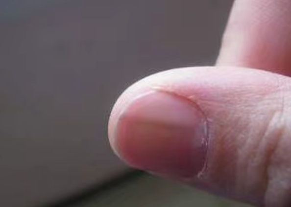 指甲上有竖纹说明身体有问题?真相来了! 指甲上有竖纹说明身体有问题?真相来了!