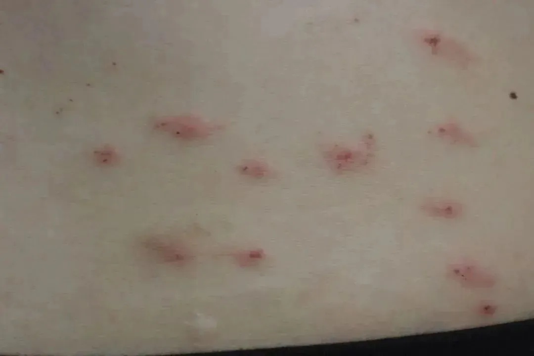 一觉醒来,身上密密麻麻全是红点!最近很多人都在用→ 一觉醒来,身上密密麻麻全是红点!最近很多人都在用→