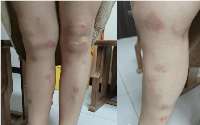 一觉醒来,身上密密麻麻全是红点!最近很多人都在用→ 一觉醒来,身上密密麻麻全是红点!最近很多人都在用→