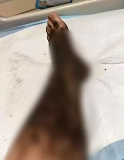 确认剧毒！妻子出电梯就被毒蛇咬伤，丈夫一个动作急救保命