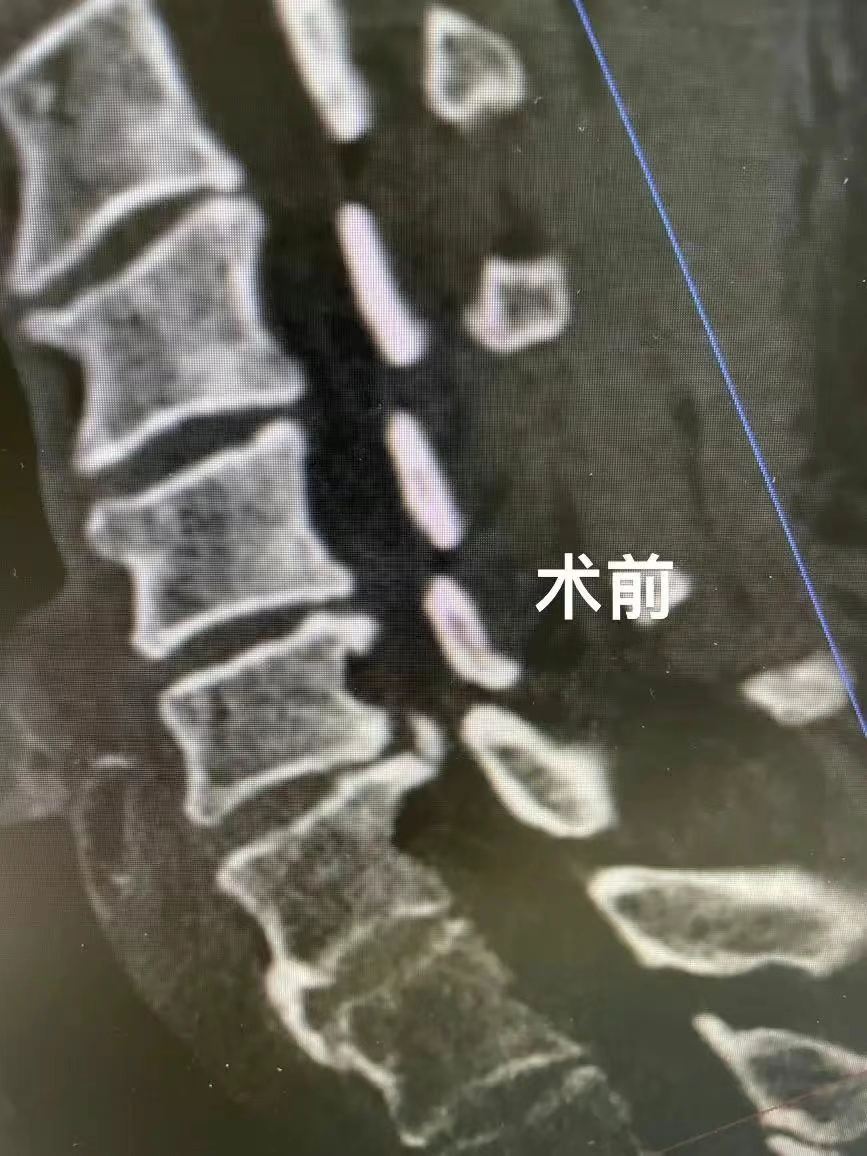 男子脚趾突然“失灵”!医生:病根在脖子 男子脚趾突然“失灵”!医生:病根在脖子