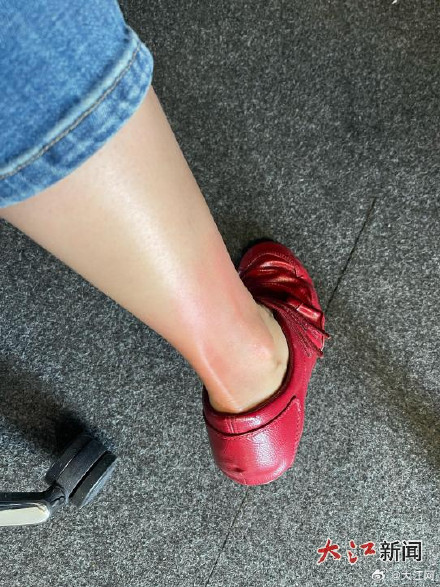 福州一女子一觉醒来浑身长满红疹,“罪魁祸首”是螨虫 福州一女子一觉醒来浑身长满红疹,“罪魁祸首”是螨虫