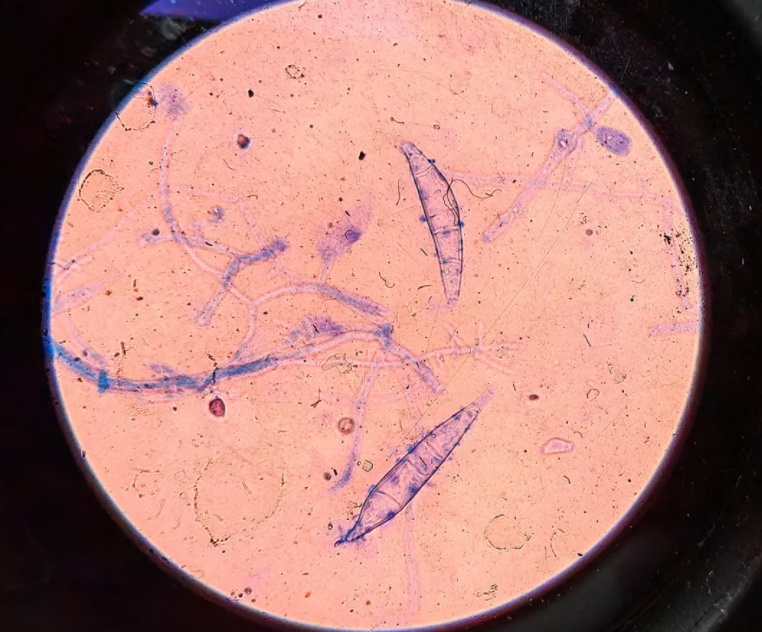 突然确诊!8岁女孩被查出……家里有这种情况的立马排查! 突然确诊!8岁女孩被查出……家里有这种情况的立马排查!