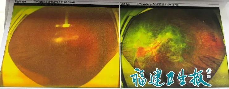 患糖尿病7年不重视!福建37岁男子悲剧了,面临左腿截肢,双眼几近失明 患糖尿病7年不重视!福建37岁男子悲剧了,面临左腿截肢,双眼几近失明