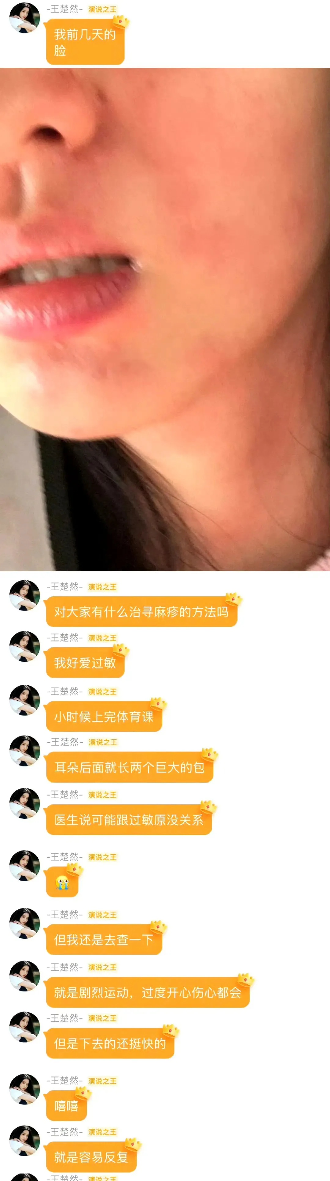 26岁演员王楚然求助荨麻疹治疗方法,网友:太有共鸣,令人崩溃! 26岁演员王楚然求助荨麻疹治疗方法,网友:太有共鸣,令人崩溃!