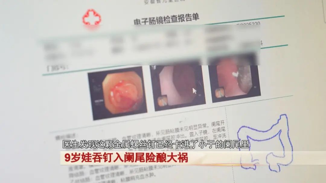 9岁娃吞钉入阑尾，险酿大祸
