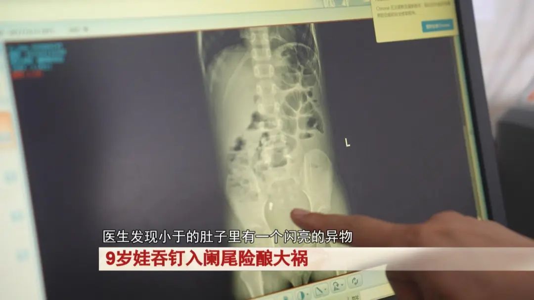 9岁娃吞钉入阑尾，险酿大祸
