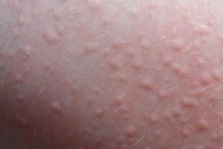 “痒到崩溃”…女演员晒照求助,网友大呼感同身受 “痒到崩溃”…女演员晒照求助,网友大呼感同身受