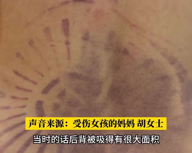 男孩整条左腿被泳池死死“咬住”,暑期带娃去泳池的家长请提高警惕! 男孩整条左腿被泳池死死“咬住”,暑期带娃去泳池的家长请提高警惕!