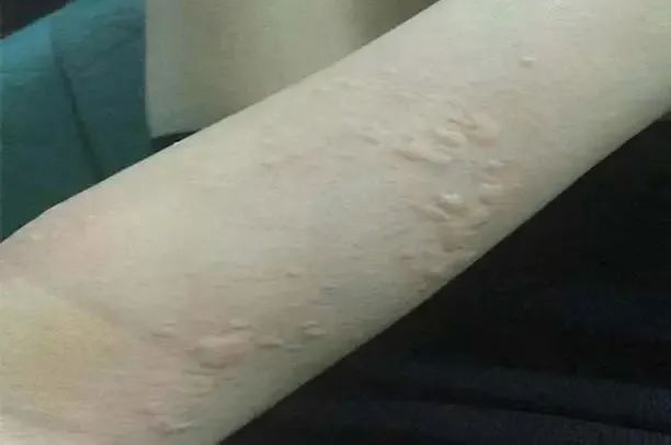 “痒到崩溃”…女演员晒照求助,网友大呼感同身受 “痒到崩溃”…女演员晒照求助,网友大呼感同身受