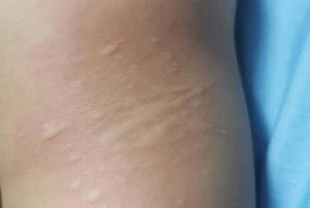 “痒到崩溃”…女演员晒照求助,网友大呼感同身受 “痒到崩溃”…女演员晒照求助,网友大呼感同身受