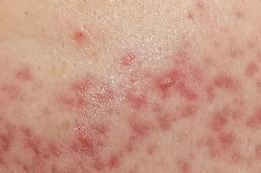 “痒到崩溃”…女演员晒照求助,网友大呼感同身受 “痒到崩溃”…女演员晒照求助,网友大呼感同身受