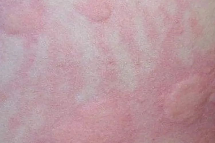 “痒到崩溃”…女演员晒照求助,网友大呼感同身受 “痒到崩溃”…女演员晒照求助,网友大呼感同身受