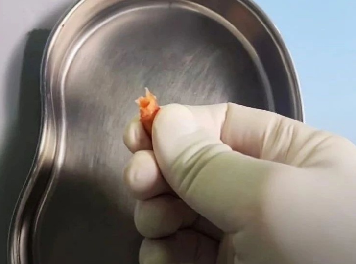 血管变“水泥管”！医生：别乱吃，血管斑块硬得跟石头一样！