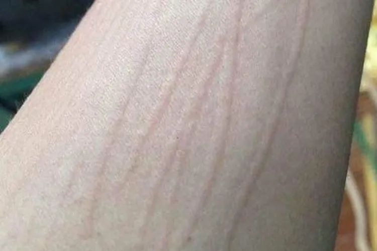 “痒到崩溃”…女演员晒照求助,网友大呼感同身受 “痒到崩溃”…女演员晒照求助,网友大呼感同身受