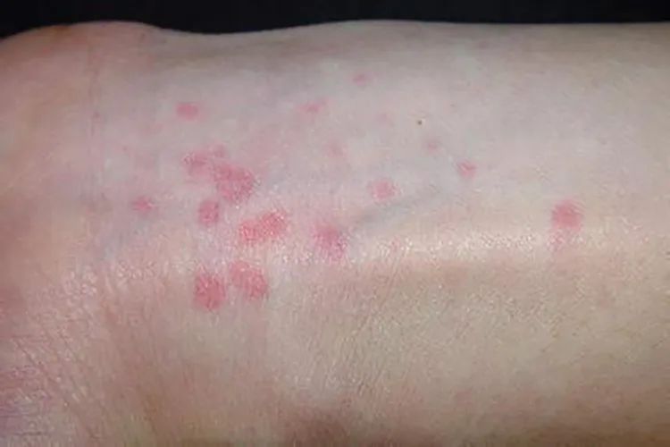 “痒到崩溃”…女演员晒照求助,网友大呼感同身受 “痒到崩溃”…女演员晒照求助,网友大呼感同身受