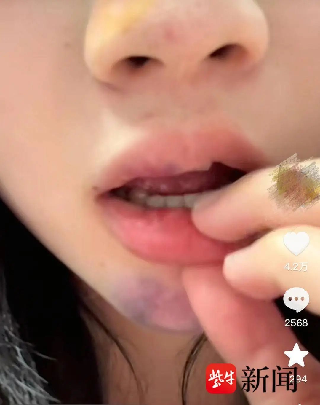 20岁女子景区蹦极被撞，确诊脑震荡！回忆经过：以为脸上是眼泪，一摸是血！景区回应