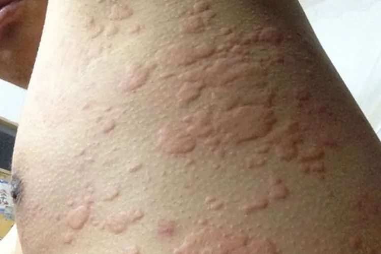 “痒到崩溃”…女演员晒照求助,网友大呼感同身受 “痒到崩溃”…女演员晒照求助,网友大呼感同身受