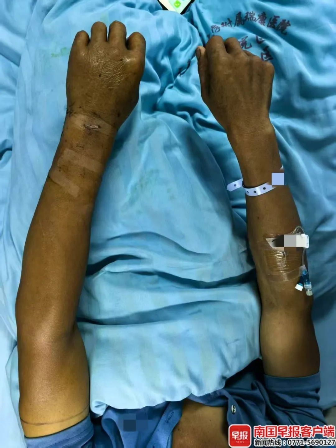 广西养蛇人被眼镜蛇咬伤,第二天才就医!紧急提醒 广西养蛇人被眼镜蛇咬伤,第二天才就医!紧急提醒