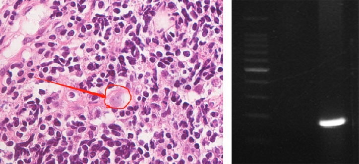 上海确诊一例!病死率高达98%,张文宏团队参与会诊 上海确诊一例!病死率高达98%,张文宏团队参与会诊