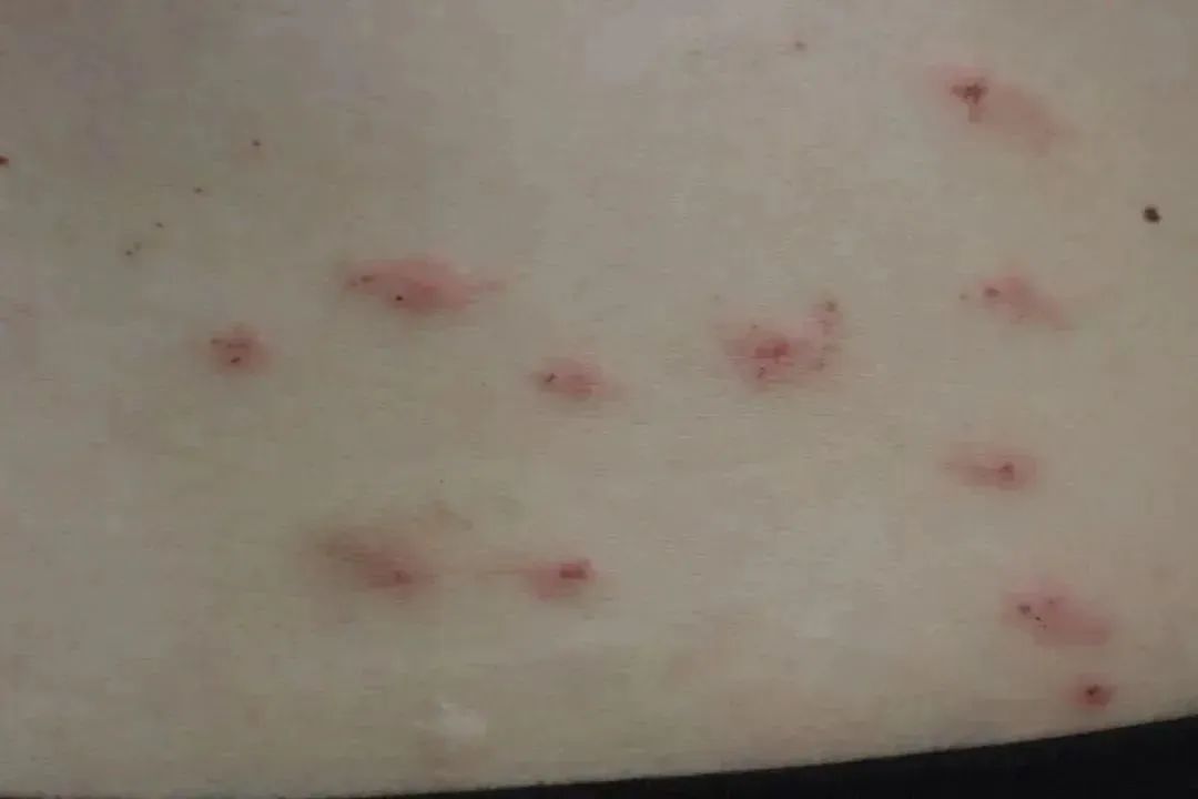 睡醒后奇痒无比，密密麻麻起疹子！很多人天天用！