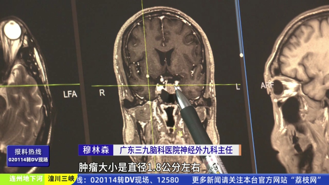 七旬老人手脚不断变大！以为这是二度发育，祸因竟是脑肿瘤→