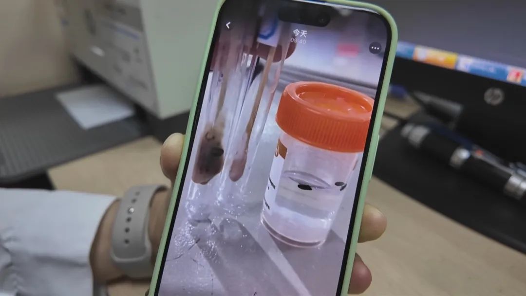 离奇！小伙脖子脓肿，开刀发现里面有7颗瓜子……