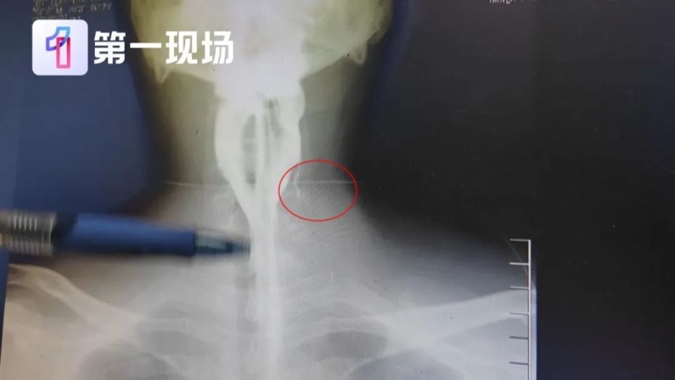 小伙脖子脓肿，开刀发现里面有7颗瓜子藏了20年