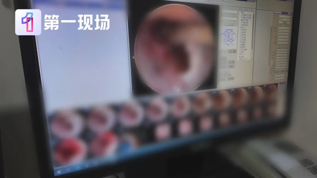 离奇！小伙脖子脓肿，开刀发现里面有7颗瓜子……