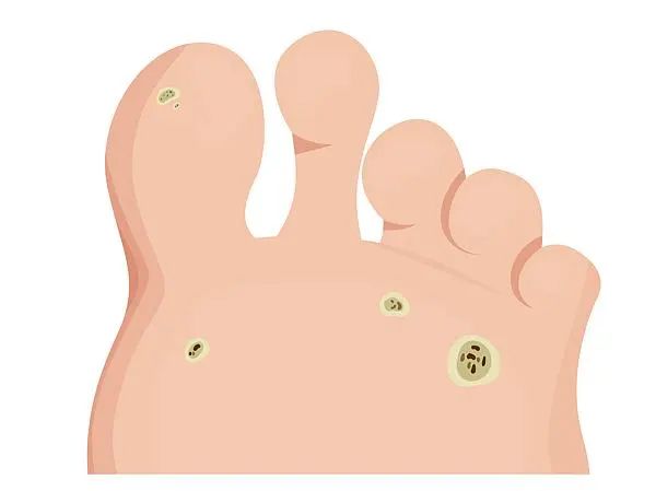 在酒店做了这件事后，竟感染了HPV？医生提醒→