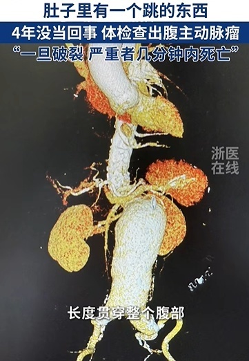 肚子里有个东西在跳!四年没当回事……体检后医生都震惊了 肚子里有个东西在跳!四年没当回事……体检后医生都震惊了