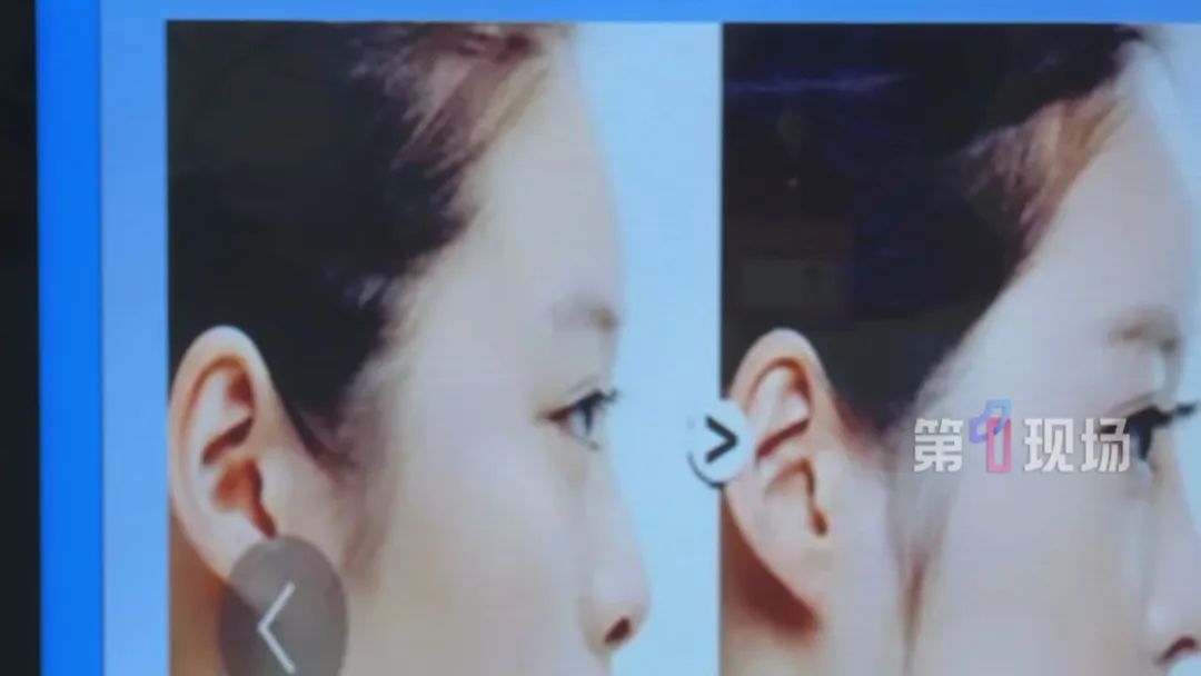 高考后“医美潮”来袭！医生：这些坑千万别踩