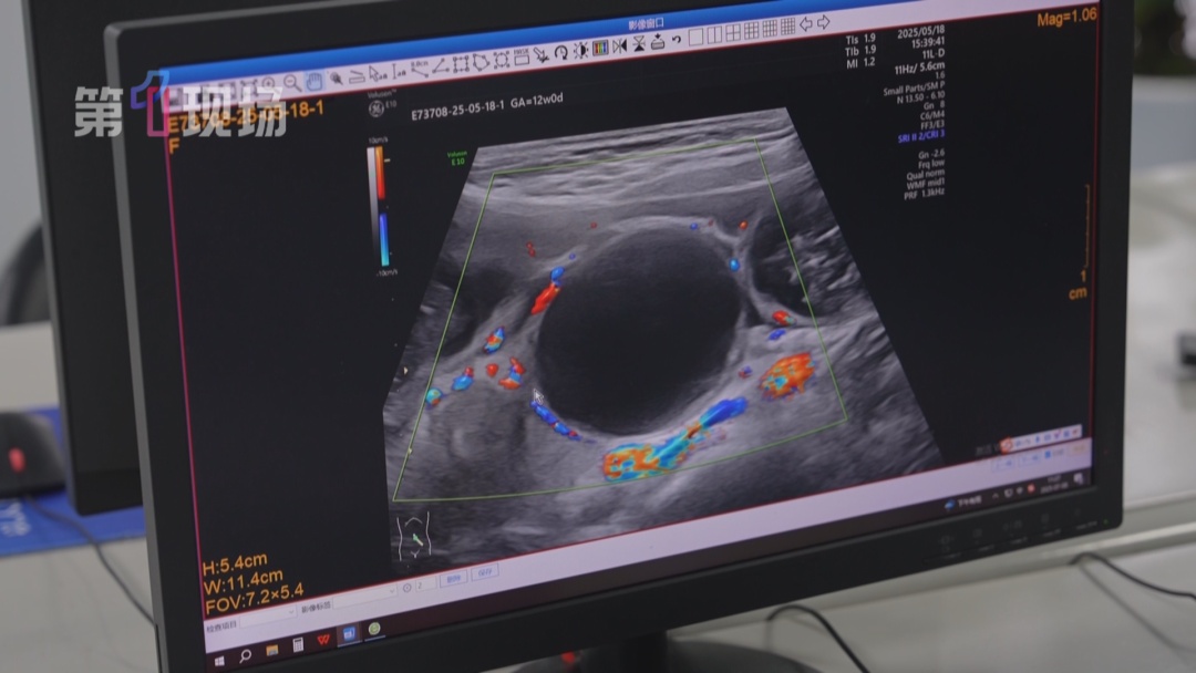 一岁幼儿吞食“水宝宝”差点肠穿孔！医生连夜手术抢救