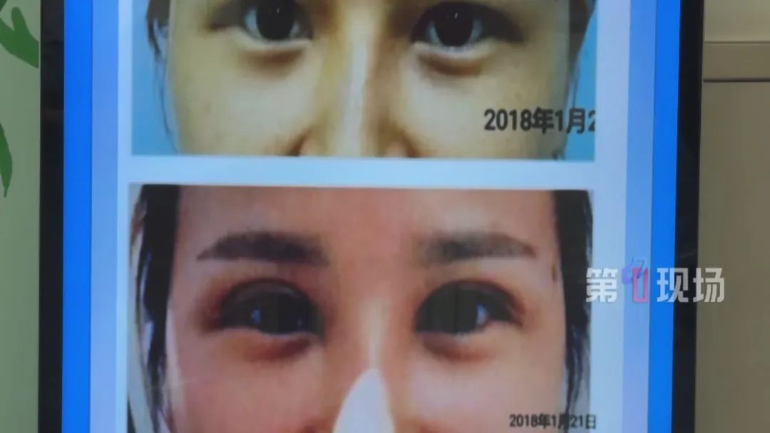 高考后“医美潮”来袭！医生：这些坑千万别踩